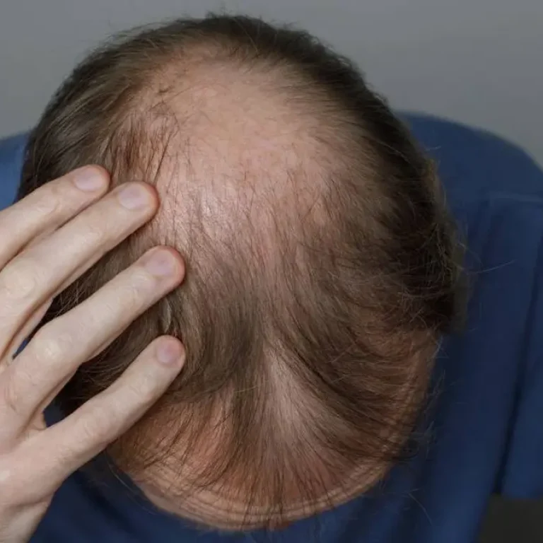 DHT-Related Hair Loss