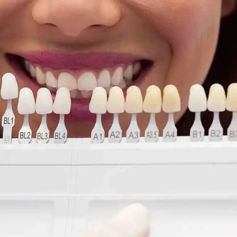 Porcelain-Crown-Color-Selection