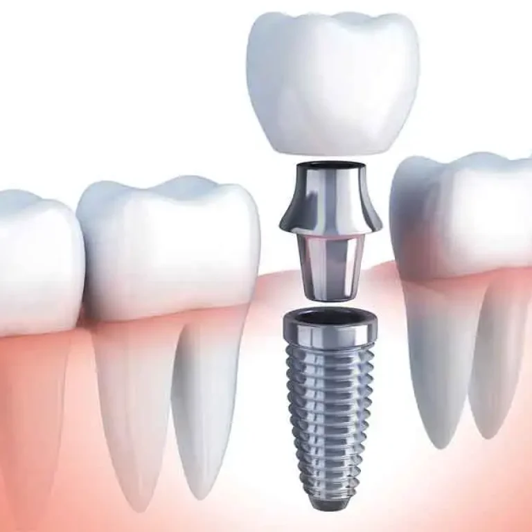 biohorizons-dental-implants