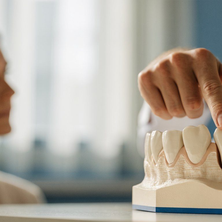Dentist using a jaw model to explain bone support around a missing tooth