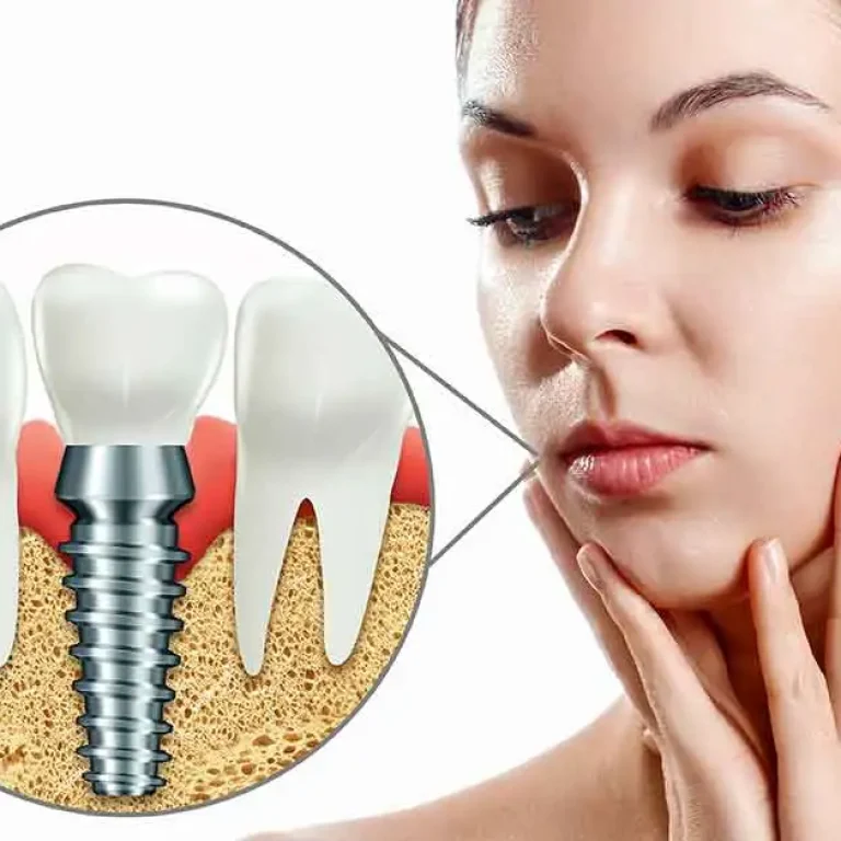 dental-implant-prices