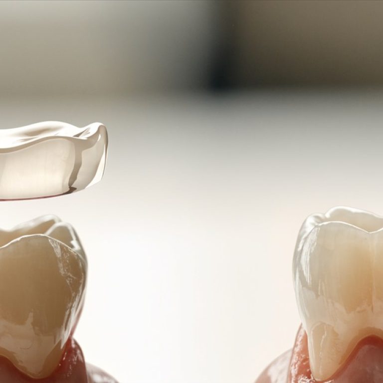 Thin ceramic veneer and direct composite bonding shown side by side on realistic front tooth models