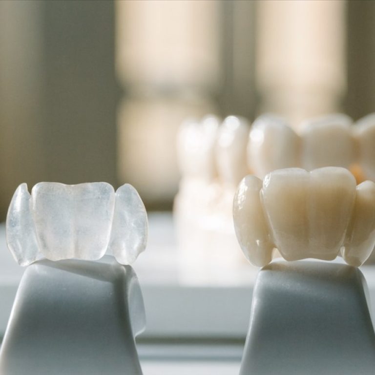 Thin E-max-style veneer and full zirconia crown shown side by side for dental treatment comparison