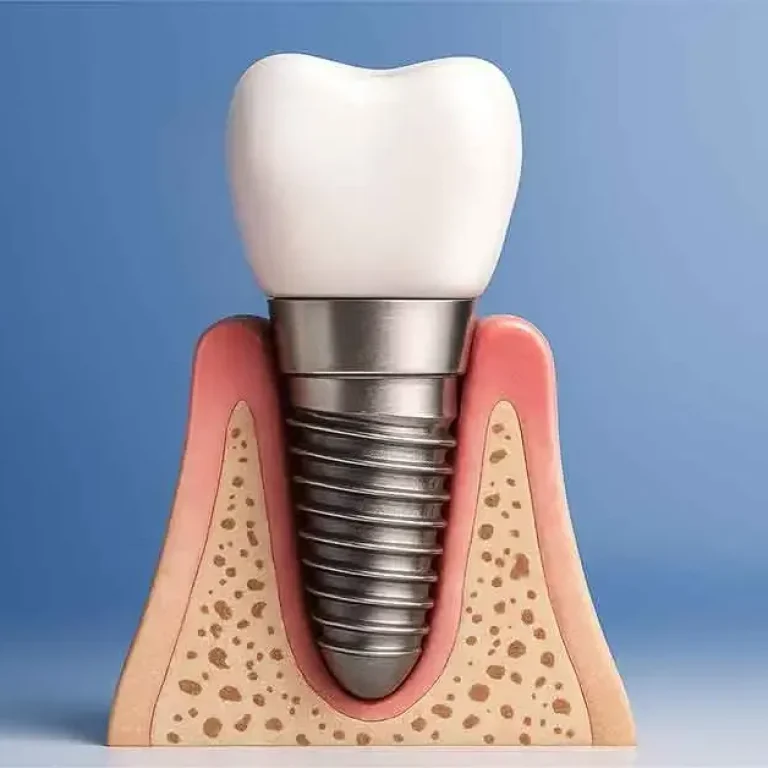 Euroteknika dental implant treatment consultation at Niva Aesthetic