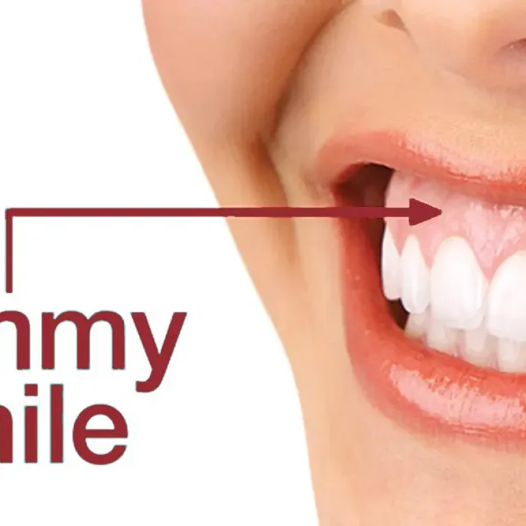 gummy-smile