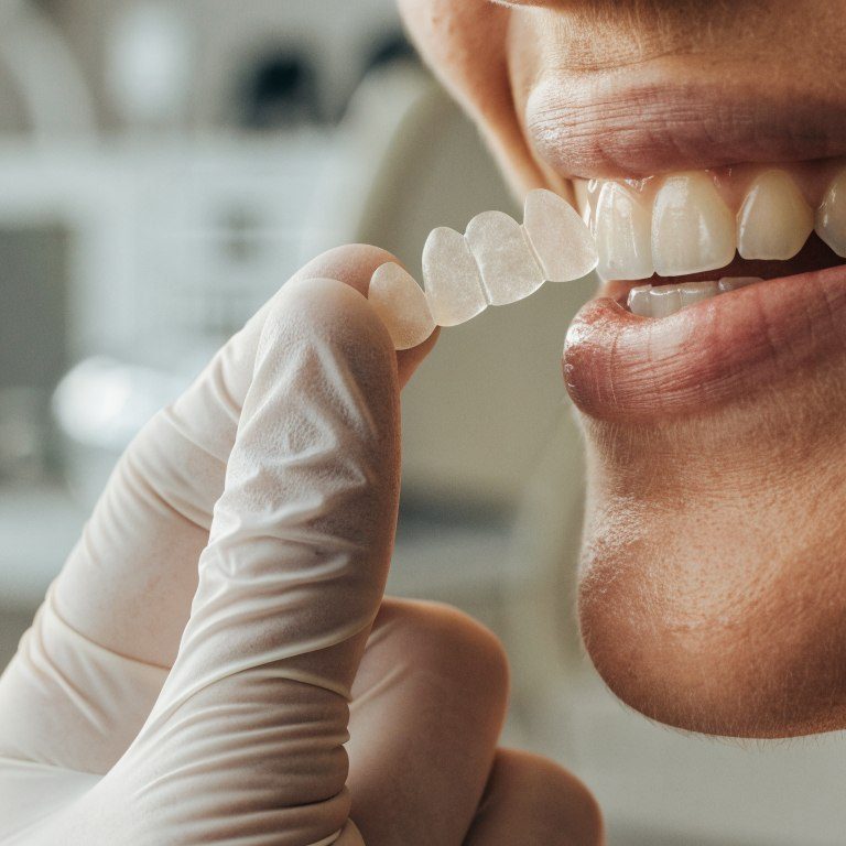 Natural smile and thin translucent ceramic veneer sample showing realistic shade and light transmission