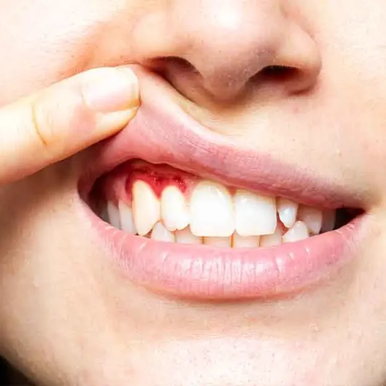 periodontal-diseases