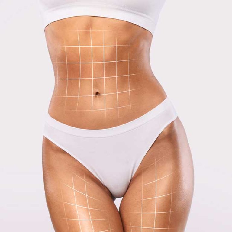 tummy-tuck-with-niva-image